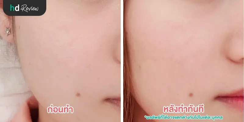 รีวิว เลเซอร์รักษารอยแผลเป็นจากสิวและหลุมสิว ที่ The Sign Clinic 11 ภาพก่อนทำเลเซอร์รักษารอยแผลเป็นจากสิวและหลุมสิว เทียบกับภาพหลังทำทันที