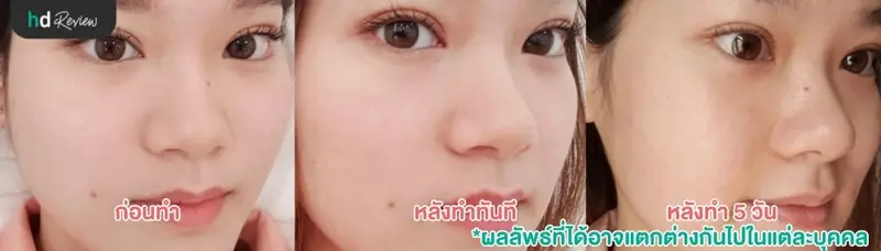 รีวิว เลเซอร์รักษารอยแผลเป็นจากสิวและหลุมสิว ที่ The Sign Clinic 13 ภาพก่อนทำ หลังทำทันที และหลังทำ 5 วัน