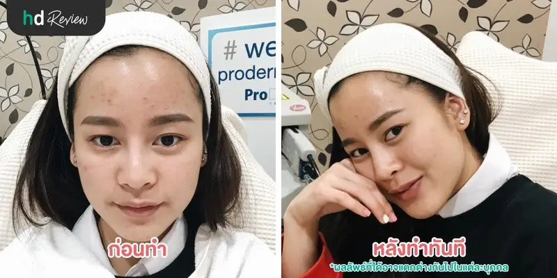รีวิว Vbeam Laser เพื่อให้หน้าสดไร้รอยสิว ที่ Proderma Aesthetic Clinics 9 ผลลัพธ์หลังจากทำ Vbeam Laser เพื่อให้หน้าสดไร้รอยสิว ที่ Proderma Aesthetic Clinics