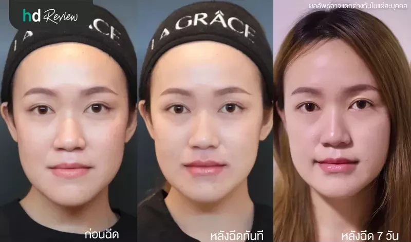 เปรียบเทียบผลลัพธ์ก่อนและหลังฉีดฟิลเลอร์ปาก ที่ La Grace Clinic