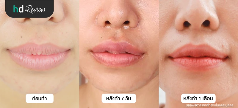 ภาพเปรียบเทียบก่อนทำปากกระจับ หลังทำ 7 วัน และหลังทำ 1 เดือน