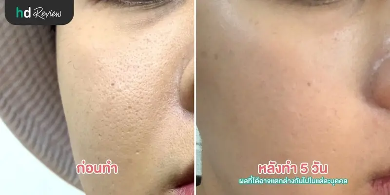 content review mtpl laser at sc skinclub clinic by