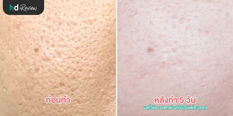 content review mtpl laser at sc skinclub clinic by