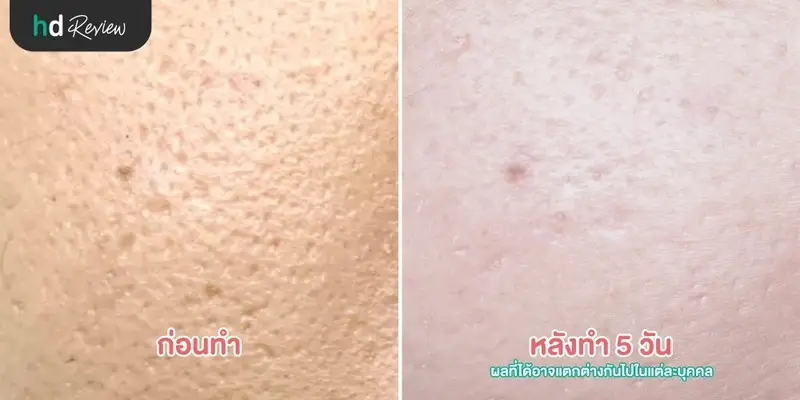 content review mtpl laser at sc skinclub clinic by
