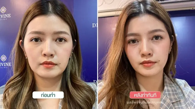 รีวิว ยกกระชับ ทำหน้าเรียว New HIFU Revolution ที่ Divine Aesthetic Clinic