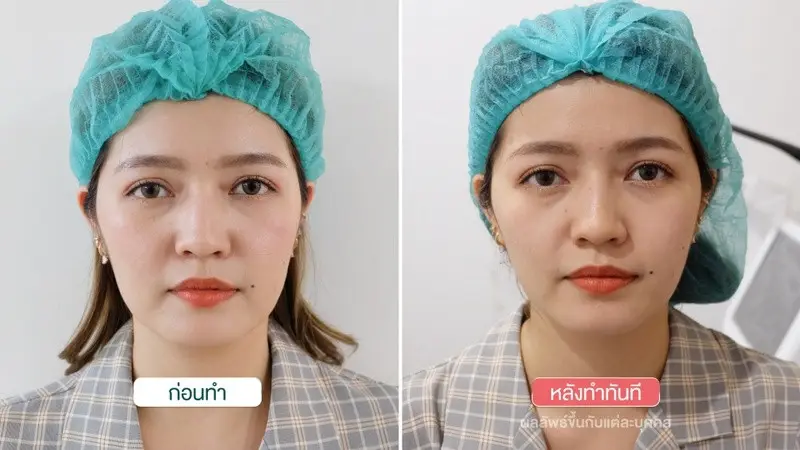 รีวิว ยกกระชับ ทำหน้าเรียว New HIFU Revolution ที่ Divine Aesthetic Clinic