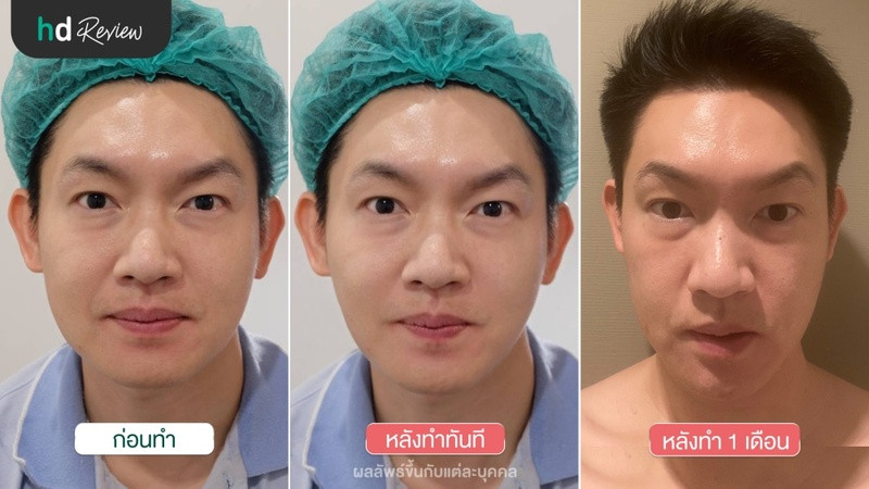 รีวิว New HIFU Revolution ยกกระชับ ทำหน้าเรียว ที่ Divine Aesthetic Clinic