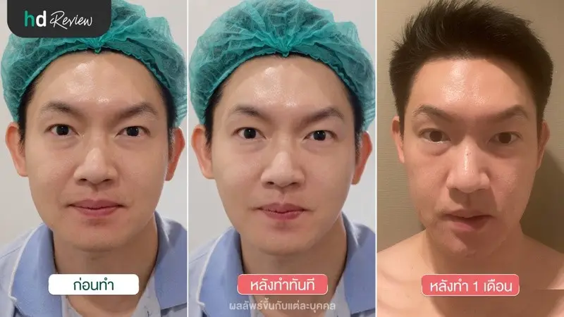 รีวิว New HIFU Revolution ยกกระชับ ทำหน้าเรียว ที่ Divine Aesthetic Clinic