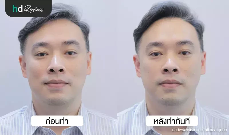 เปรียบเทียบก่อนและหลังทำ Ulthera ยกกระชับกรอบหน้าผู้ชาย
