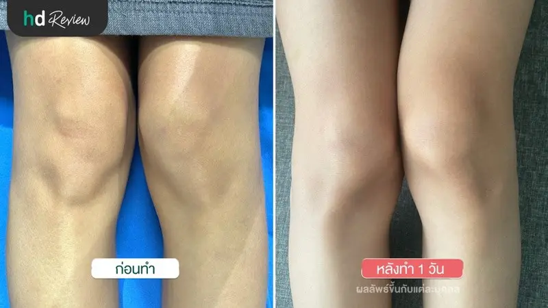 ภาพเปรียบเทียบก่อนและหลังทำเลเซอร์หัวเข่าดำ ด้วย Q-Switch ที่ Divine Aesthetic Clinic