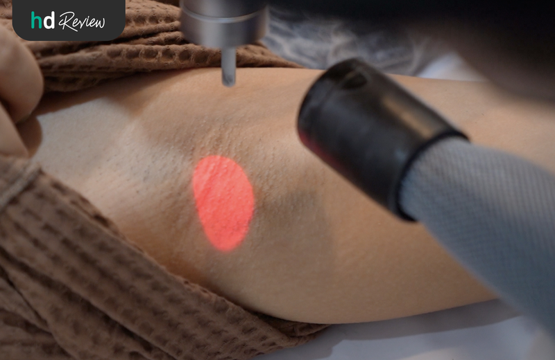 ขั้นตอนกำจัดขนรักแร้ด้วย Long Pulse ND YAG