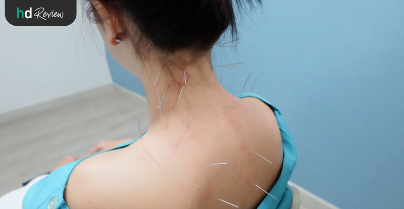 รีวิว บรรเทาอาการปวดด้วยกายภาพบำบัดและแพทย์แผนจีน ที่ ดวงกมลคลินิก