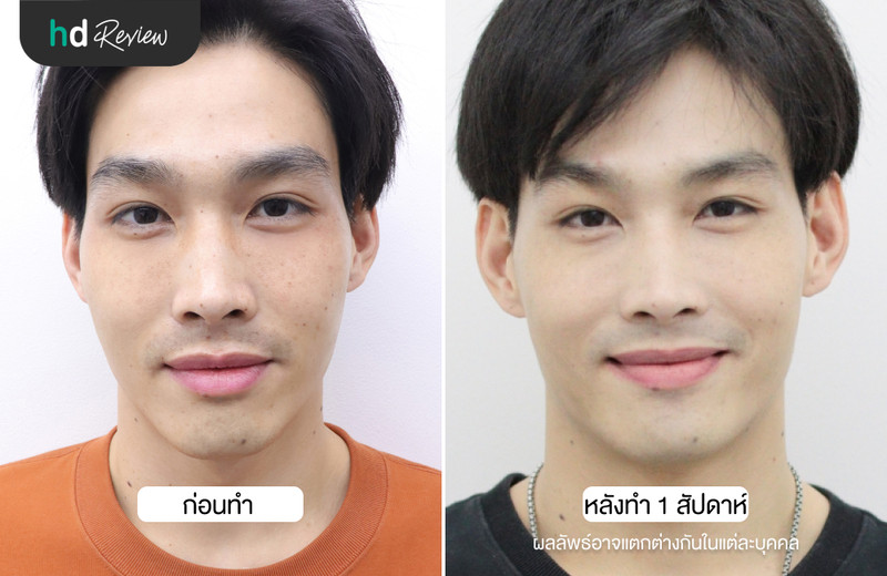 เปรียบเทียบการเลเซอร์รักษาฝ้า ด้วย Picocare 450 ที่ Flow Clinic