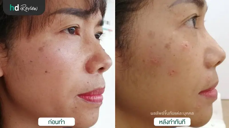 รีวิว จี้ไฝ กำจัดไฝ ด้วยเลเซอร์ CO2 ที่ โรงพยาบาลบางปะกอก รังสิต 2