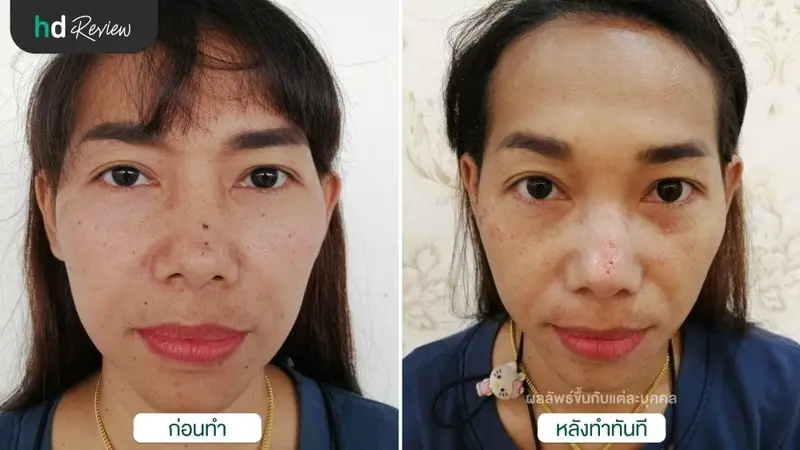 รีวิว จี้ไฝ กำจัดไฝ ด้วยเลเซอร์ CO2 ที่ โรงพยาบาลบางปะกอก รังสิต 2
