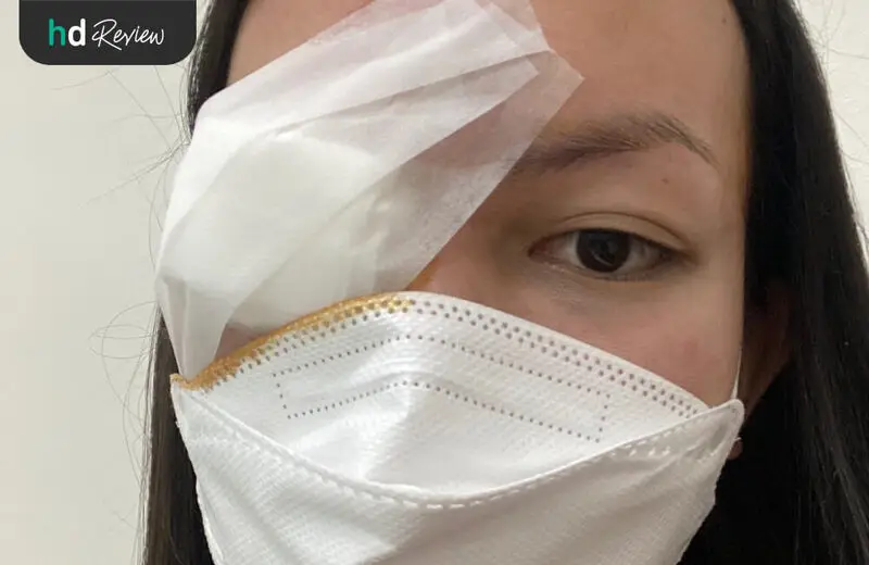 รีวิว ผ่าตัดลอกต้อเนื้อ โดยใช้เยื่อบุตามาปลูกถ่าย ที่ โรงพยาบาลสหวิทยาการมะลิ