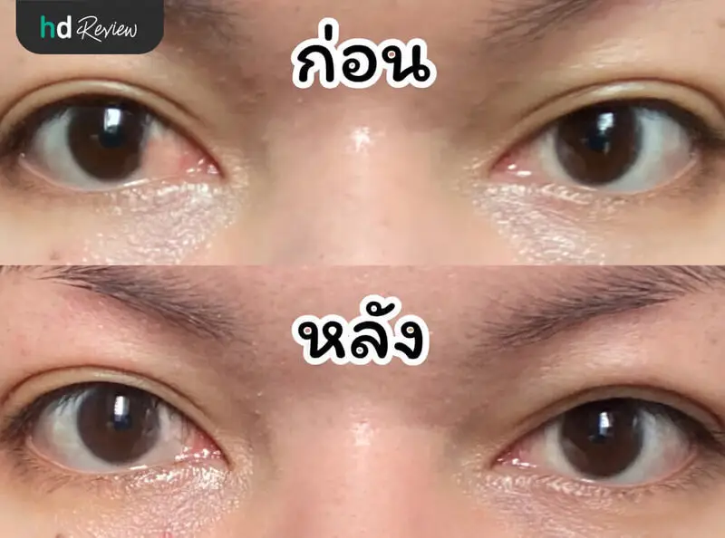 รีวิว ผ่าตัดลอกต้อเนื้อ โดยใช้เยื่อบุตามาปลูกถ่าย ที่ โรงพยาบาลสหวิทยาการมะลิ