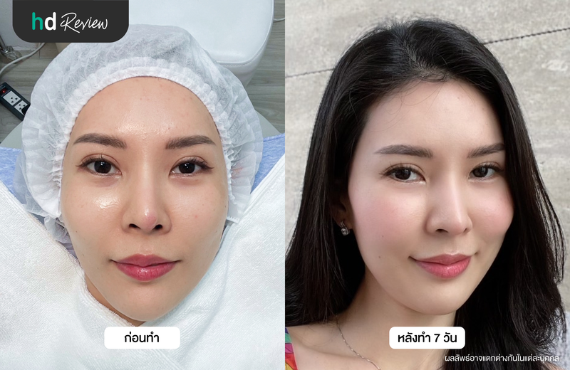 ภาพเปรียบเทียบผลลัพธ์หลังฉีดรีจูรันครบ 7 วัน