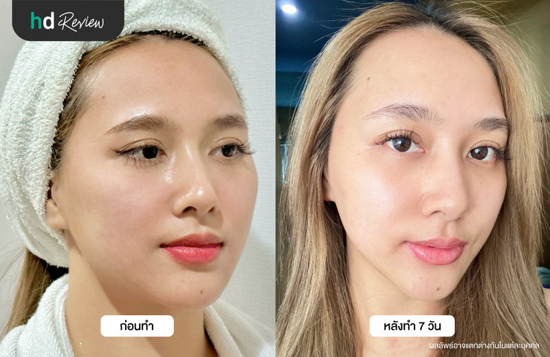 ผลลัพธ์หลังฉีด Rejuran ครบ 7 วัน