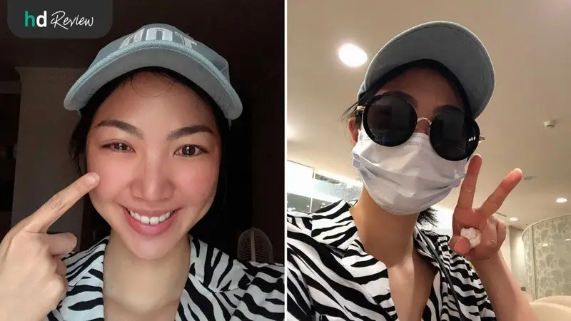 วันแรกหลังทำ ReLEx SMILE เลสิกไร้ใบมีด