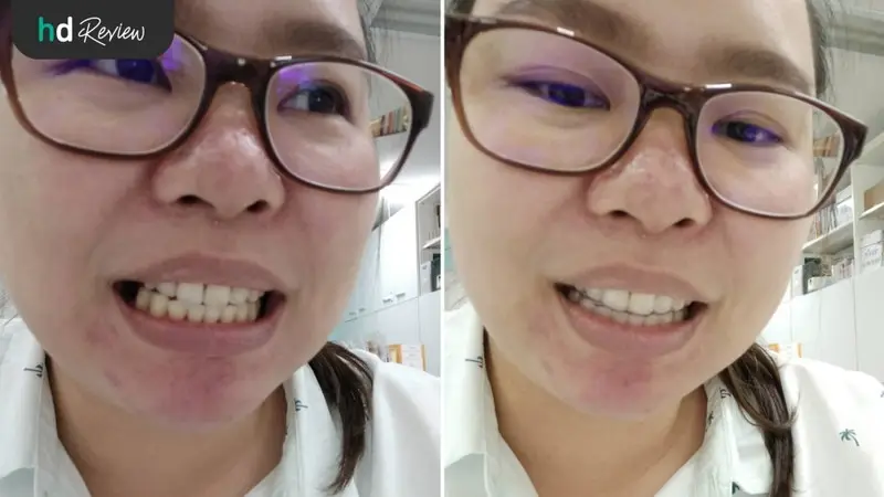 รีวิว ทำรีเทนเนอร์เติมฟันปลอม ที่ Tooth Box Dental Clinic