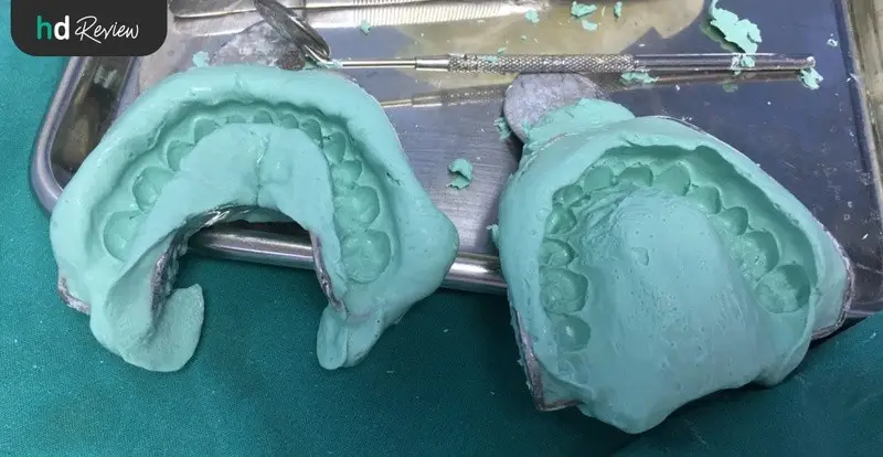 content review retainer wire at be bright dental clinic by jirarat sordsri 1