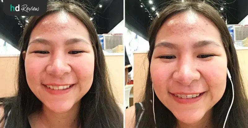 content review retainer wire at be bright dental clinic by jirarat sordsri 9