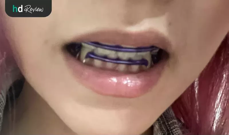 ใส่รีเทนเนอร์ลวด ทำที่ VP Dental Clinic อุดมสุข 33