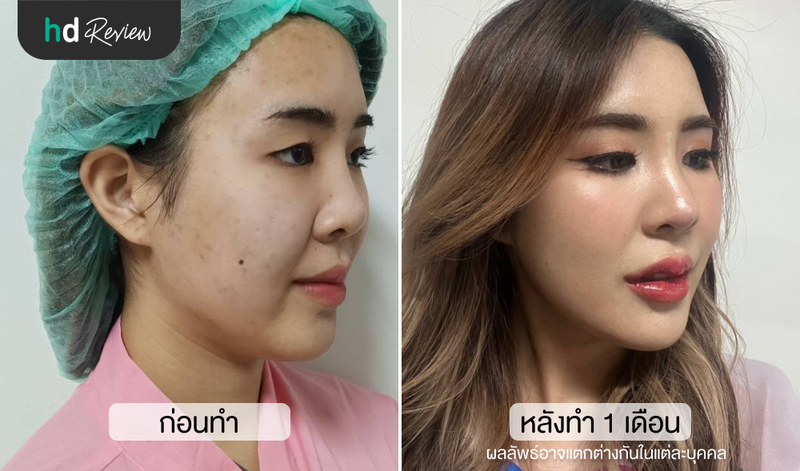 ผลลัพธ์หลังแก้จมูก เสริมจมูก ที่ The Cupid Clinic อุดมสุข