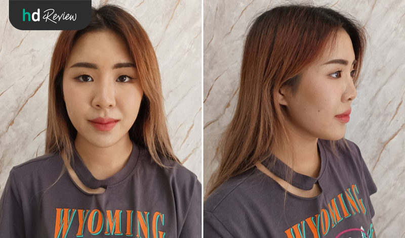 รีวิวแก้จมูก เสริมจมูก