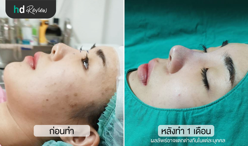 เปรียบเทียบก่อนและหลังแก้จมูกที่ The Cupid Clinic อุดมสุข