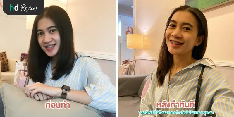 รีวิว Signature Blink นวดหน้าบำรุงผิวที่ BB Clinic 8 HDreview รีวิว Signature Blink นวดหน้า ที่ BB Clinic