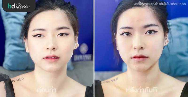 รีวิว Divine Lift ลิฟท์กรอบหน้า และเมโสหน้าใส Pink Line ที่ Divine Aesthetica Clinic