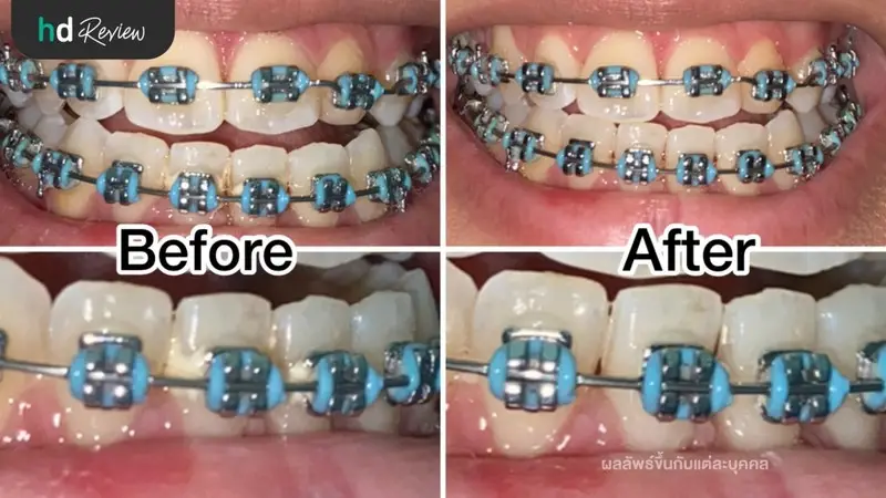 รีวิว ขูดหินปูนตอนจัดฟัน ที่ BeFun Dental Clinic