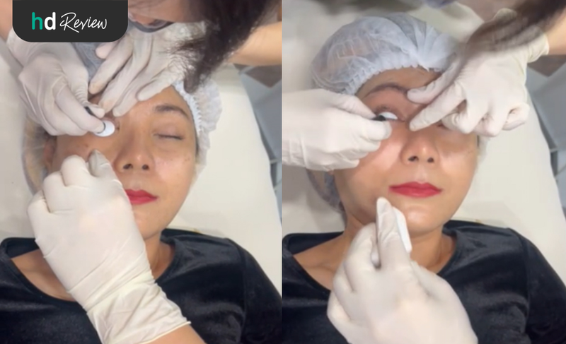 ใส่ Eyes Shield ก่อนทำ Thermage Eyes ที่ Anjali Clinic