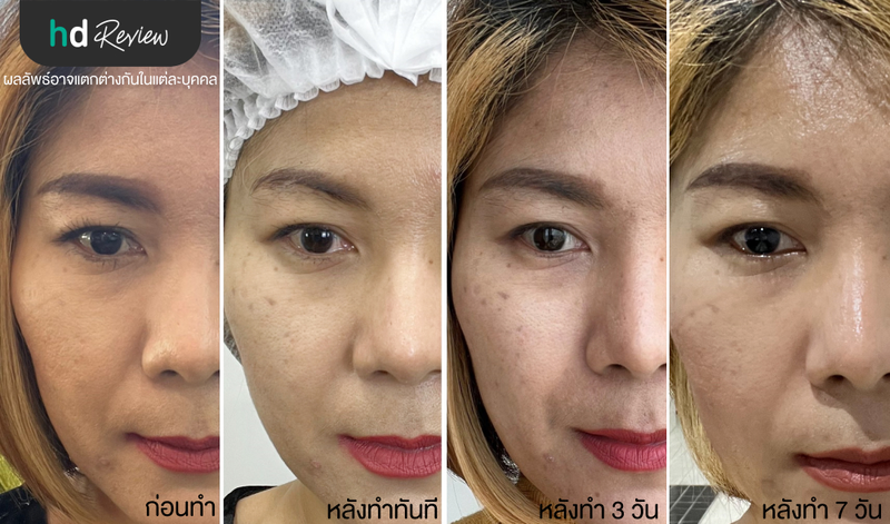 หลังทำ  Thermage Eyes ที่ Anjali Clinic 7 วัน
