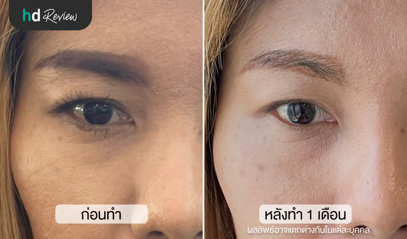หลังทำ Thermage Eyes ที่ Anjali Clinic 1 เดือน