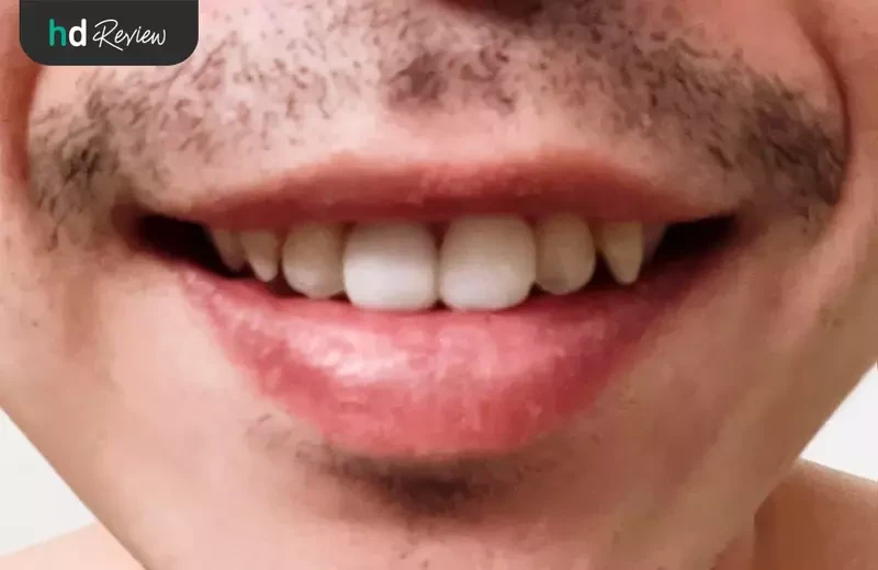 ผลลัพธ์หลังทำวีเนียร์ แปะฟันขาว ด้วยวีเนียร์คอมโพสิต ที่ Grace Dental Clinic