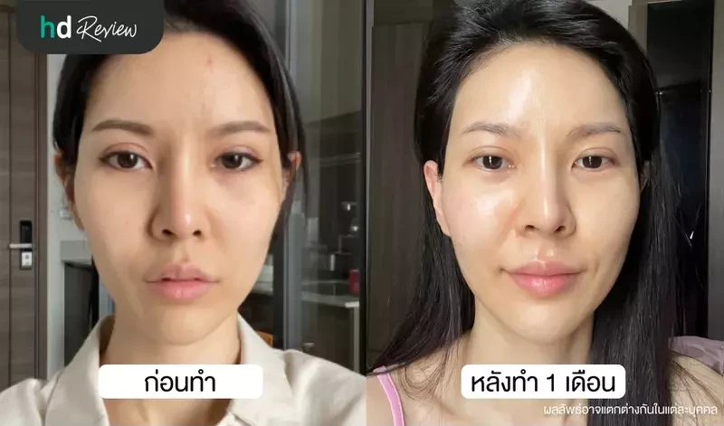 เปรียบเทียบก่อนและหลังทำ Ulthera 1 เดือน