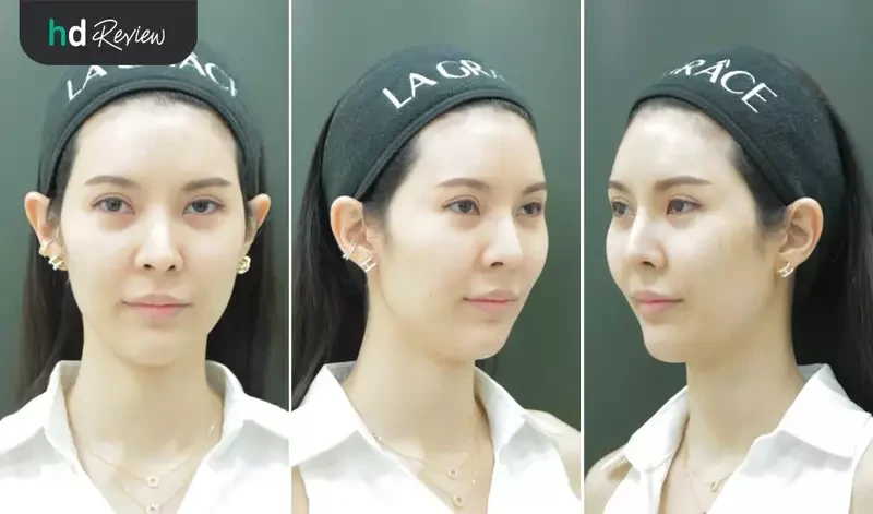 content review ulthera face at la grace clinic by watjanarat luangdilok 4