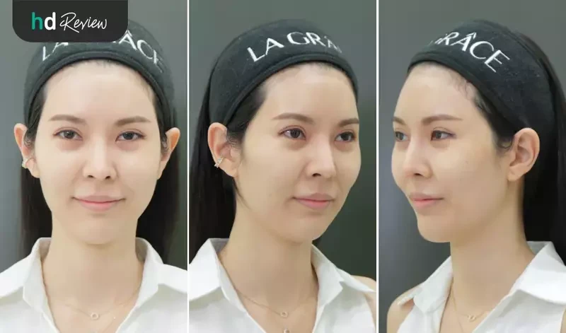 content review ulthera face at la grace clinic by watjanarat luangdilok 7