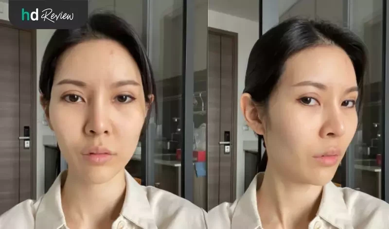 content review ulthera face at la grace clinic by watjanarat luangdilok 9