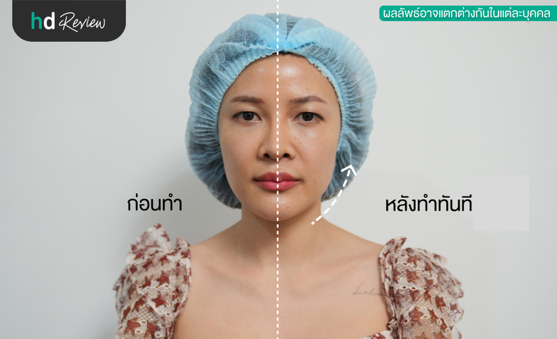 content review ultracel q plus linear hifu at begift clinic by laknara sangmaneechot 10