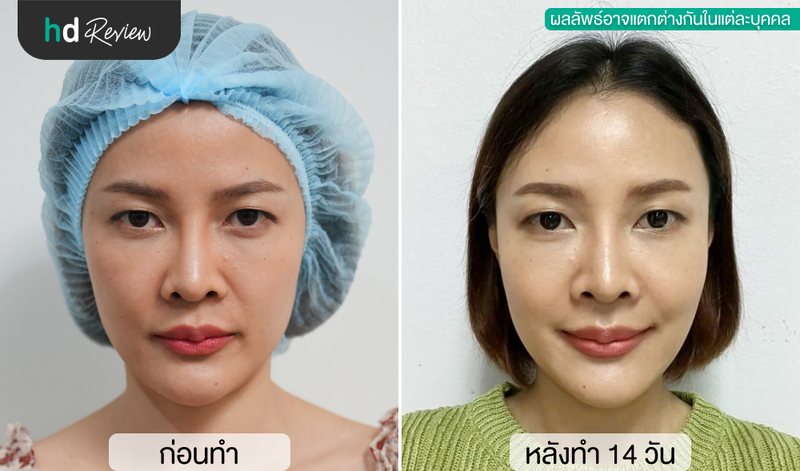 content review ultracel q plus linear hifu at begift clinic by laknara sangmaneechot 13