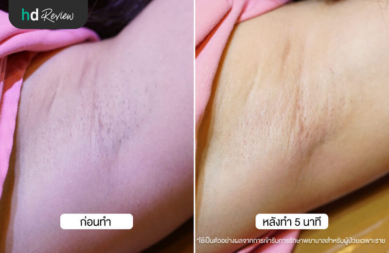 ภาพเปรียบเทียบก่อนและหลังเลเซอร์กำจัดขนรักแร้ ด้วย Gentle YAG ที่ F Clinic