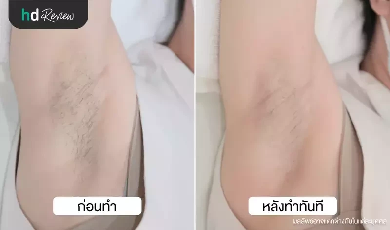 เปรียบเทียบ ก่อนและหลังกำจัดขนรักแร้ ด้วย Long Pulse ND: YAG ที่ La Grace Clinic
