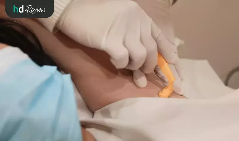โกนขนรักแร้ ก่อนกำจัดขนรักแร้ ด้วย Long Pulse ND: YAG ที่ La Grace Clinic