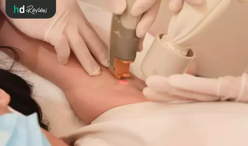 รีวิวกำจัดขนรักแร้ ด้วย Long Pulse ND: YAG ที่ La Grace Clinic