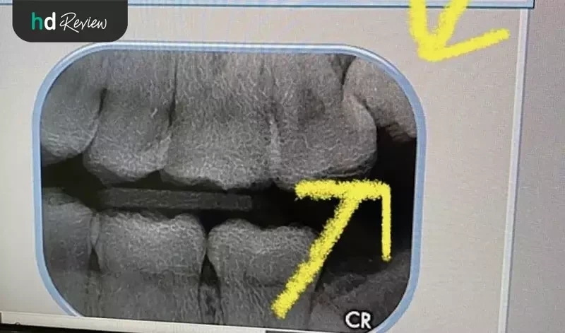 content review wisdom tooth extraction at edelweiss dental house by varisa sriplienchan 2