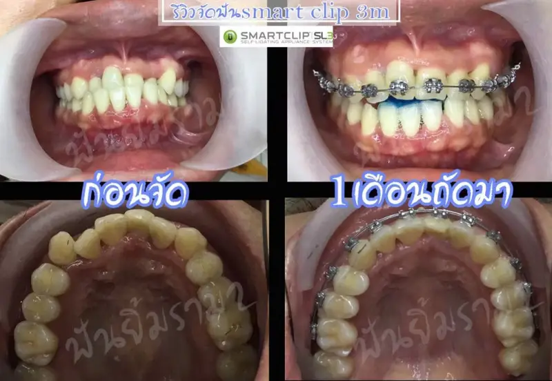 รีวิวจัดฟันแก้ฟันเหยิน ที่ คลินิกฟันยิ้ม ราม 2